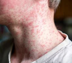 measles spots on child